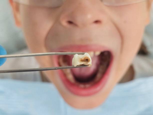 Best Broken or Cracked Tooth Emergency Dentist in Belvedere, CA